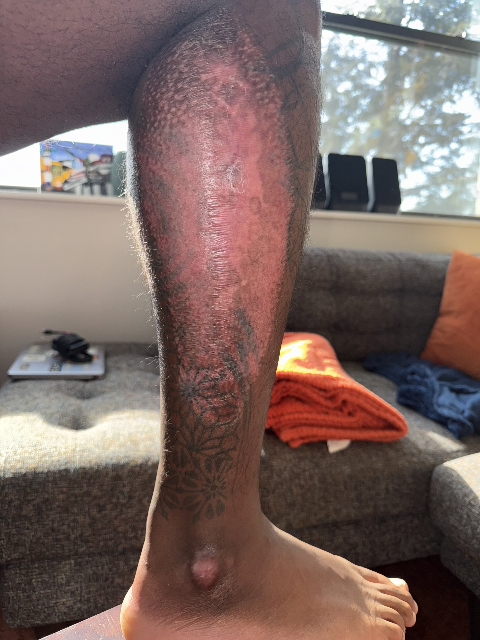 Healing road rash scarring on lower leg from the bike accident