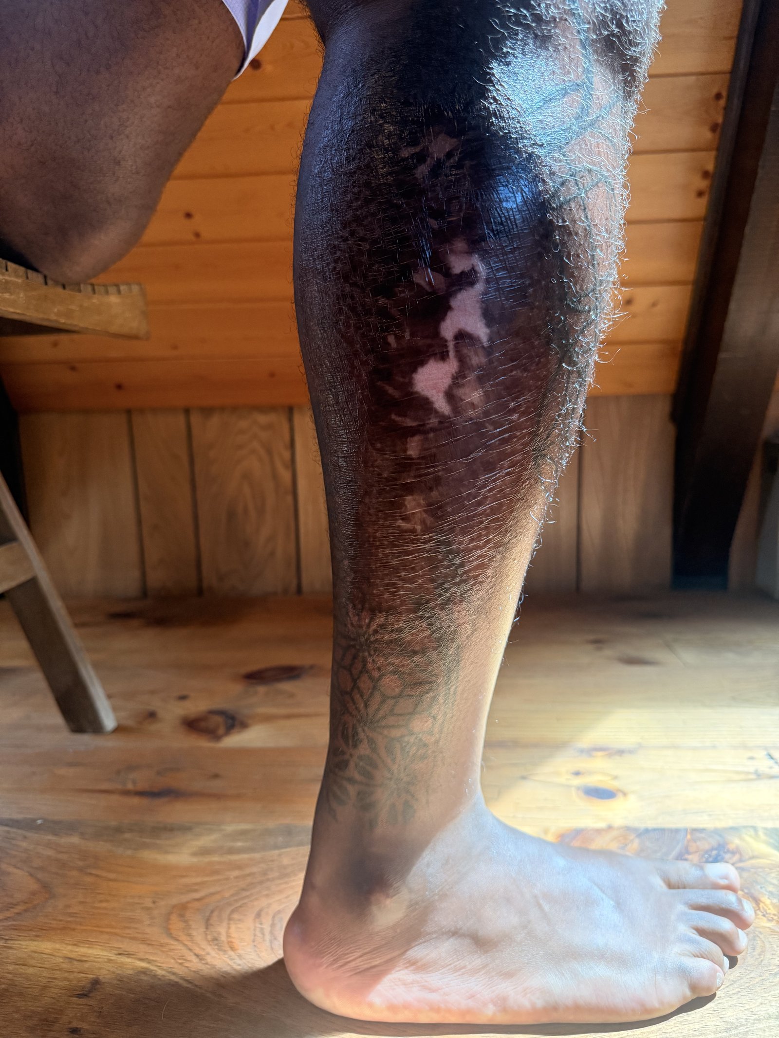Healing road rash scarring on leg, close-up angle
